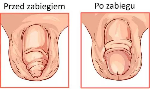 Penis przed i po obrzezaniu