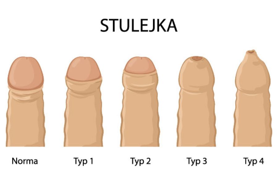 Jak zapobiec przeobrażeniu się stulejki w załupek prącia? Rodzaje stulejki