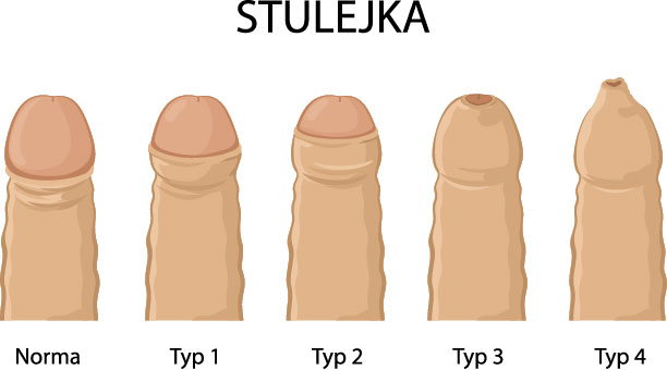 Rodzaje stulejki