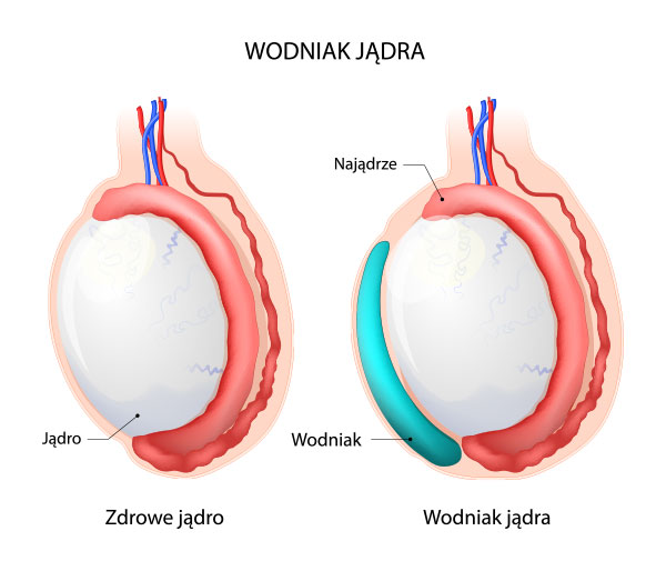 Infografika przedstawiająca wodniaka jądra, najądrze i jądro